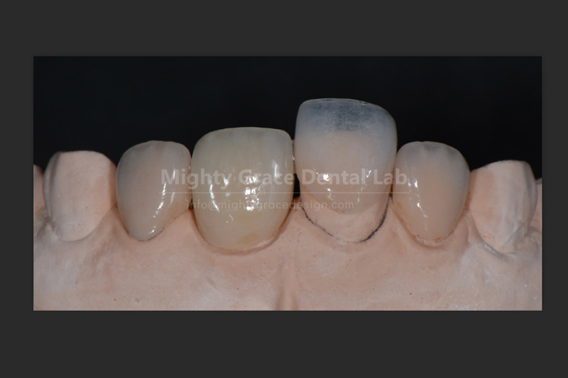 Porcelain Veneers: The Secret to a Smile That Stays Like New for Twenty Years