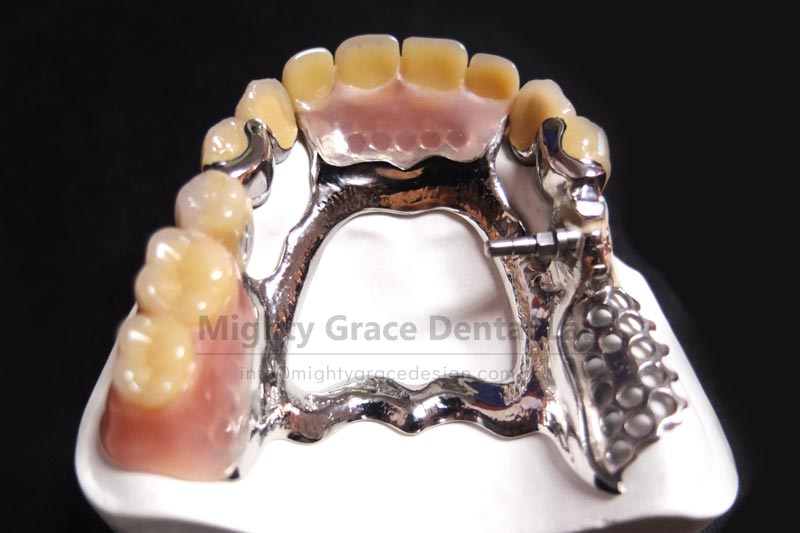 Precision Attachments: Making Removable Dentures Invisible and Stable