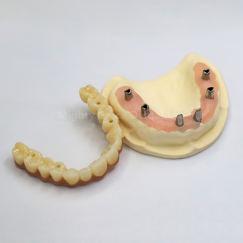 Dental Implant