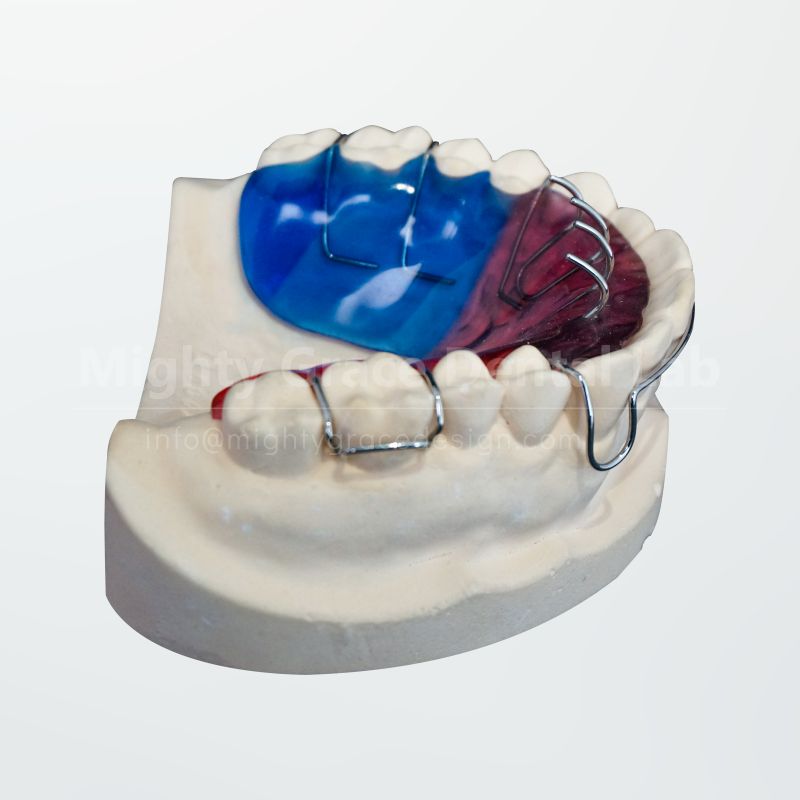 Tongue Habit Appliance