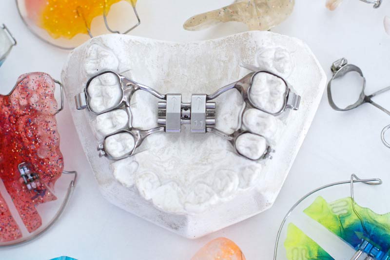 Rapidly Resolve Dental Crowding, Reshape the Perfect Jaw – Hyrax Rapid Expander