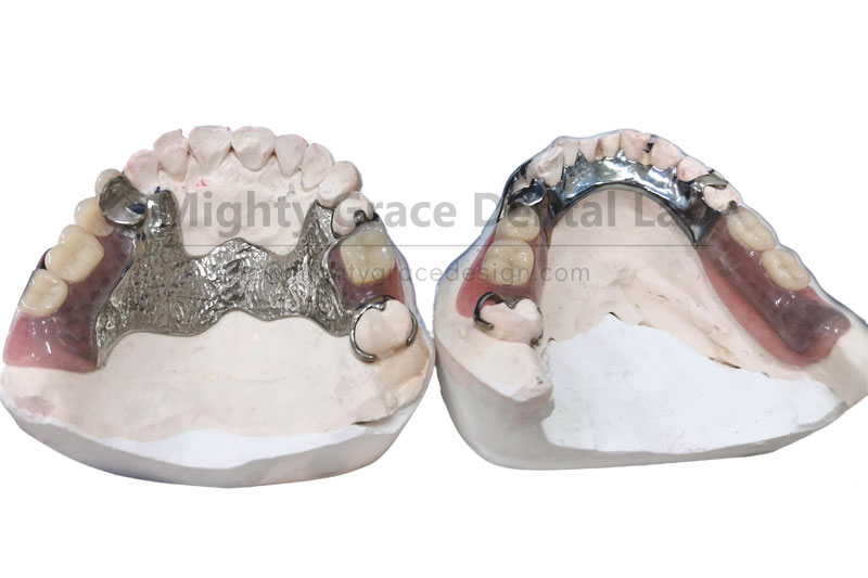 Empowering Clinical Practice: Customized Support for Precision Removable Partial Dentures