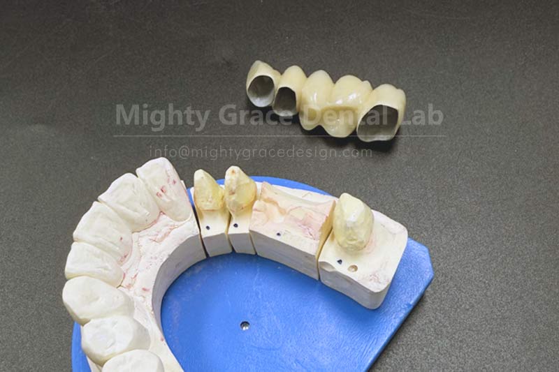 Porcelain-Fused-to-Metal Crowns: A Time-Tested Choice for Tooth Restoration
