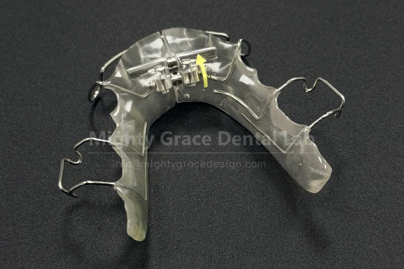 Focusing on Anterior Arch Narrowness Correction: The Fan-shaped Expander Seizes the Golden Opportunity for Treatment During the Mixed Dentition Period Focusing on Anterior Arch Narrowness Correction: The Fan-shaped Expander Seizes the Golden Opportunity for Treatment During the Mixed Dentition Period