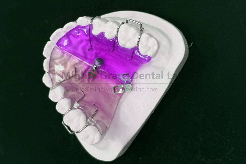 Focusing on Anterior Arch Narrowness Correction: The Fan-shaped Expander Seizes the Golden Opportunity for Treatment During the Mixed Dentition Period
